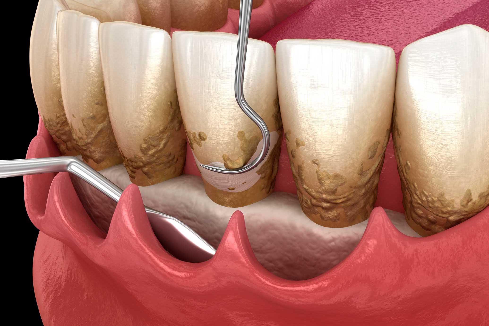 periodoncia en Torre del Mar, tratamiento para las encías en Torre del Mar, encías sanas.