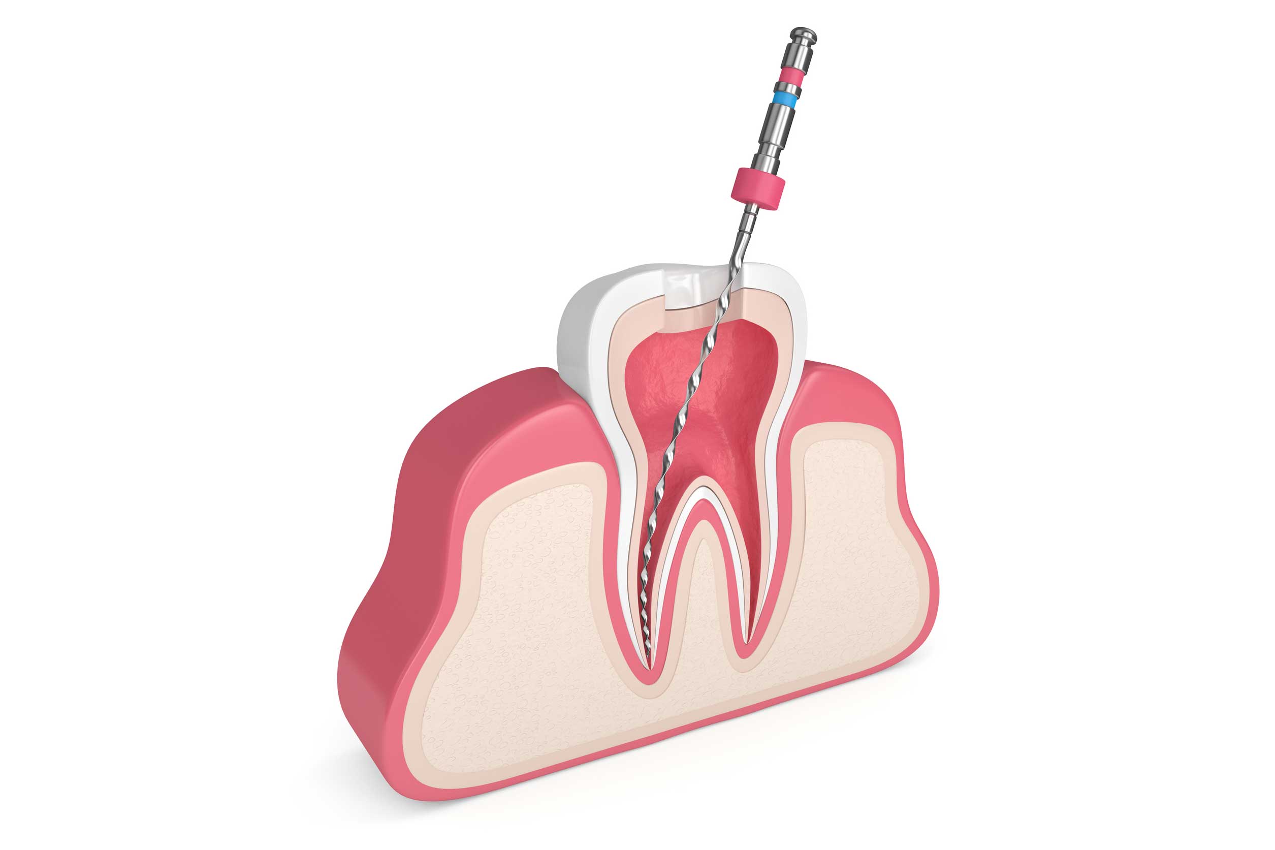 endodoncia en Torre del Mar, tratamiento de conductos en Torre del Mar.