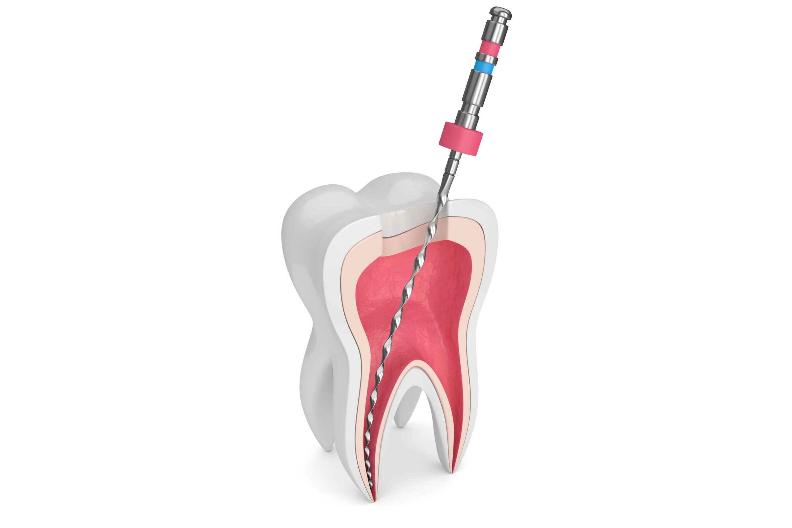 endodoncia en Torre del Mar, tratamiento de conductos en Torre del Mar.