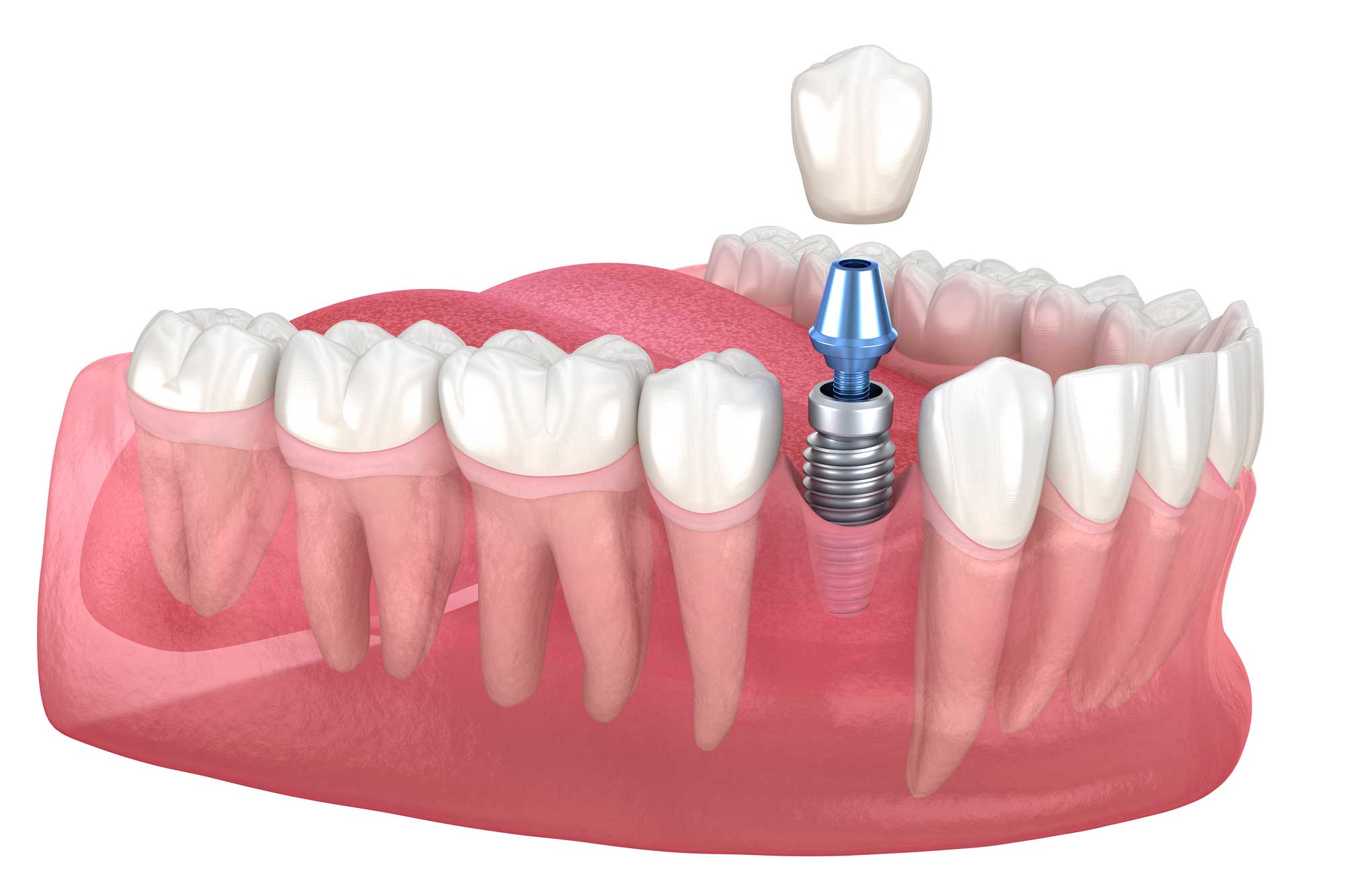 implantes dentales en Torre del Mar, Implantología Oral en Torre del Mar, implantes en Torre del Mar.