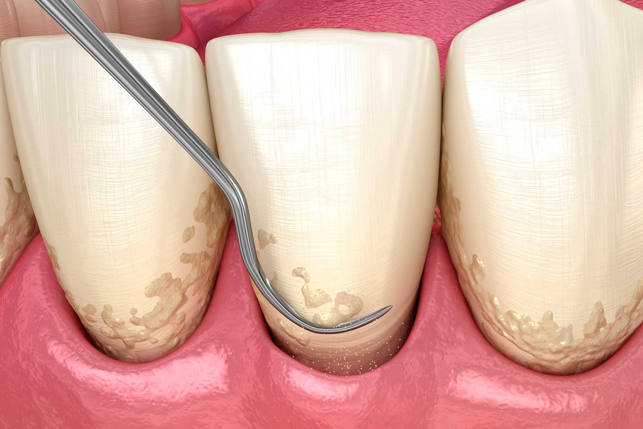 periodoncia en Torre del Mar, tratamiento para las encías en Torre del Mar, encías sanas.