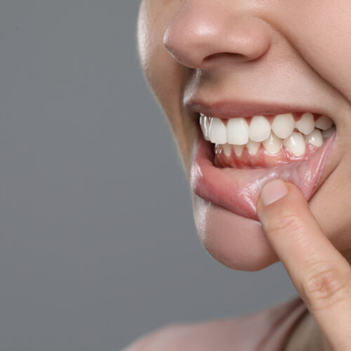 Periodoncia: ¿Qué es y cuáles son los principales tratamientos?